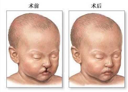造成婴儿兔唇的原因解析 预防关键在于怀孕早期