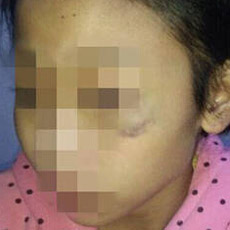 11女孩被养父母虐待 全身多处伤疤