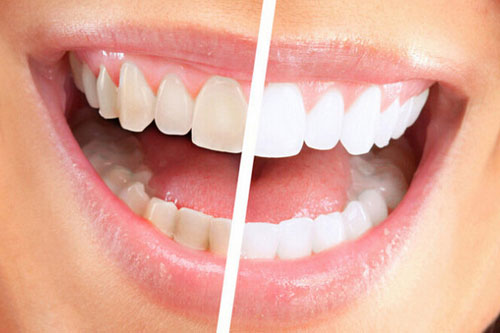 牙齿发黄的原因有哪些 美白牙齿的方法妙招